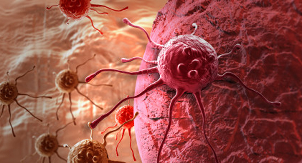 Brilliant new implant could stop metastasis of cancer cells